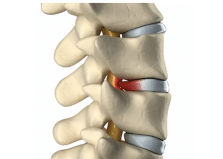 What Are the Signs That Your Herniated Disc Is Healing?
